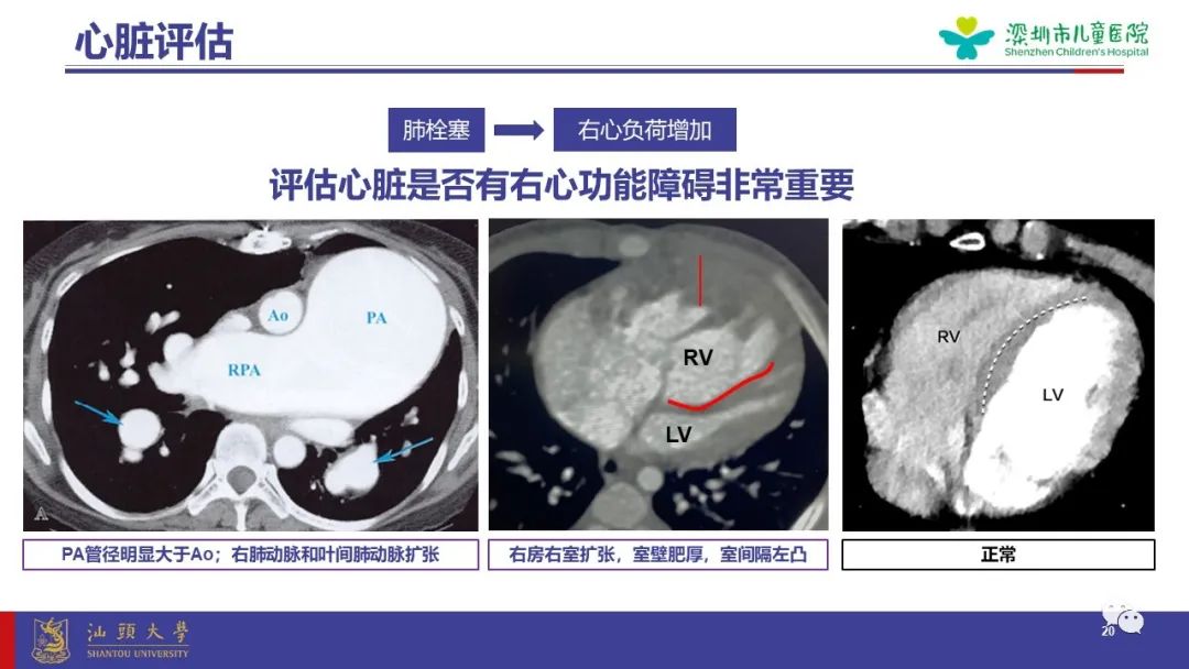 影像PPT - 【PPT】肺血管疾病-20