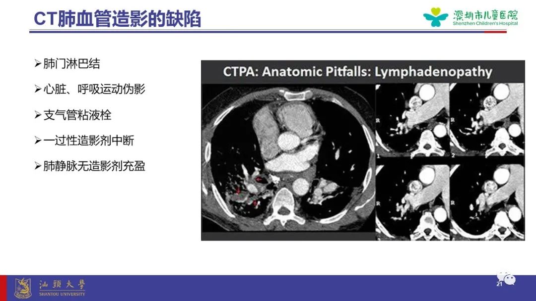 影像PPT - 【PPT】肺血管疾病-21