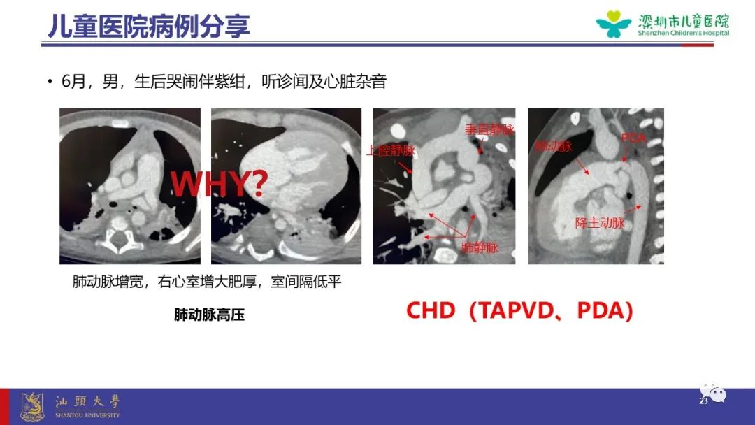 影像PPT - 【PPT】肺血管疾病-23