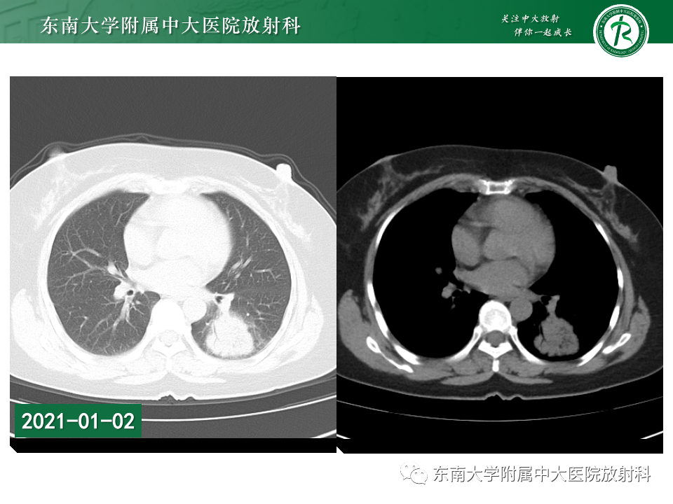 影像PPT - 【PPT】非典型性肺炎—以鹦鹉热衣原体感染为例-2