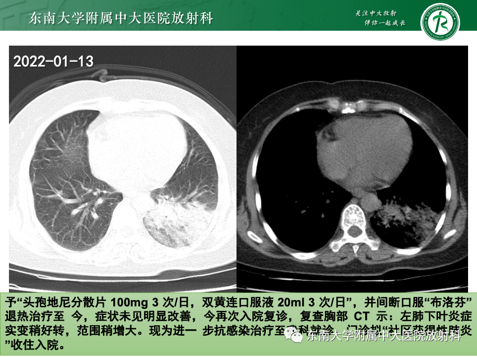 影像PPT - 【PPT】非典型性肺炎—以鹦鹉热衣原体感染为例-4
