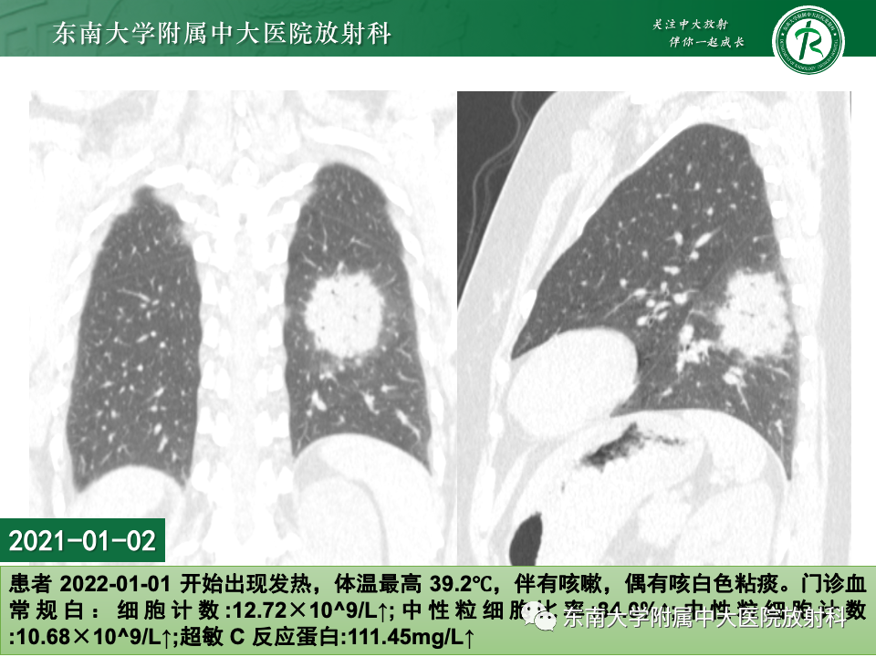 影像PPT - 【PPT】非典型性肺炎—以鹦鹉热衣原体感染为例-3