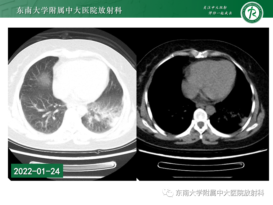 影像PPT - 【PPT】非典型性肺炎—以鹦鹉热衣原体感染为例-7