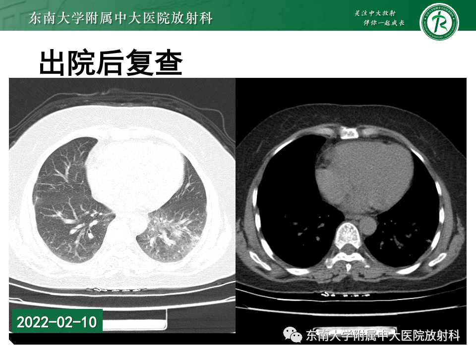 影像PPT - 【PPT】非典型性肺炎—以鹦鹉热衣原体感染为例-8