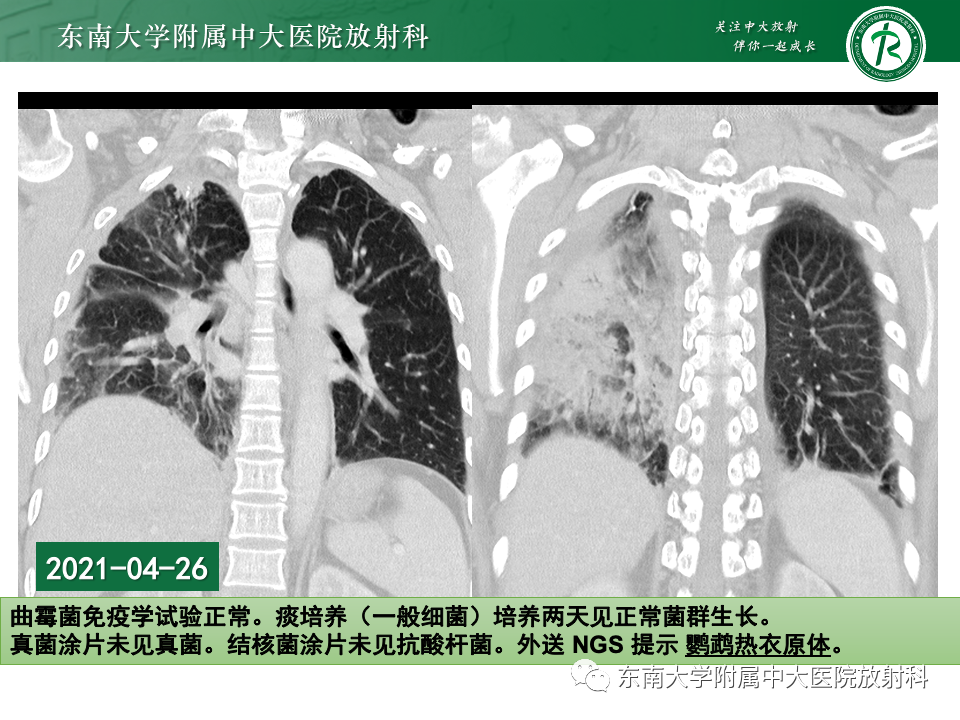 影像PPT - 【PPT】非典型性肺炎—以鹦鹉热衣原体感染为例-12