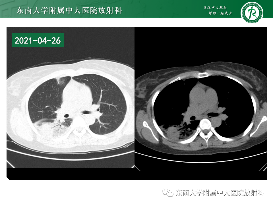 影像PPT - 【PPT】非典型性肺炎—以鹦鹉热衣原体感染为例-10