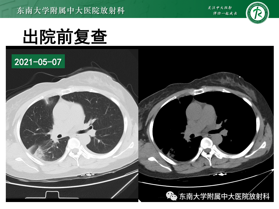 影像PPT - 【PPT】非典型性肺炎—以鹦鹉热衣原体感染为例-13