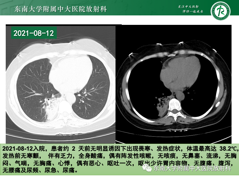 影像PPT - 【PPT】非典型性肺炎—以鹦鹉热衣原体感染为例-15