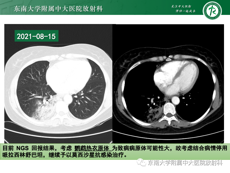 影像PPT - 【PPT】非典型性肺炎—以鹦鹉热衣原体感染为例-16