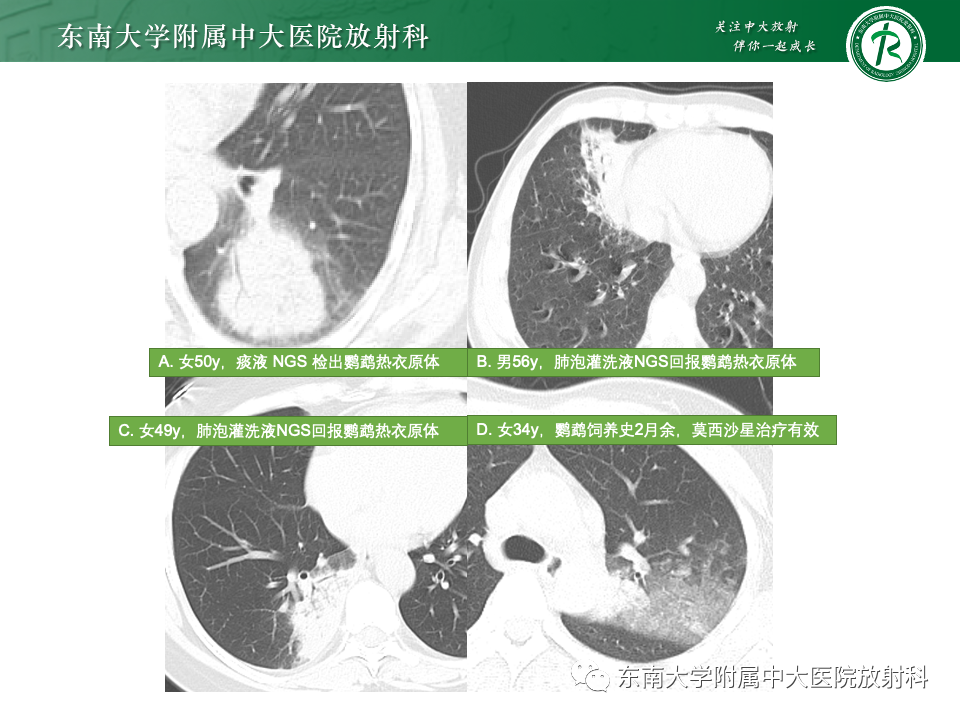 影像PPT - 【PPT】非典型性肺炎—以鹦鹉热衣原体感染为例-34