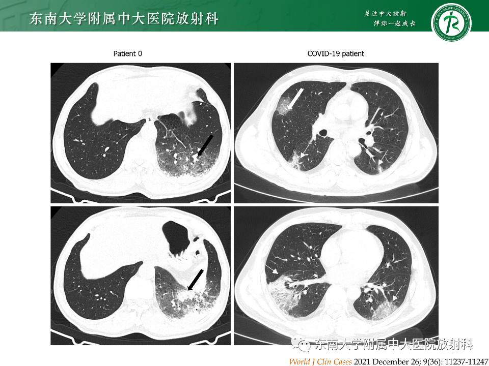 影像PPT - 【PPT】非典型性肺炎—以鹦鹉热衣原体感染为例-36