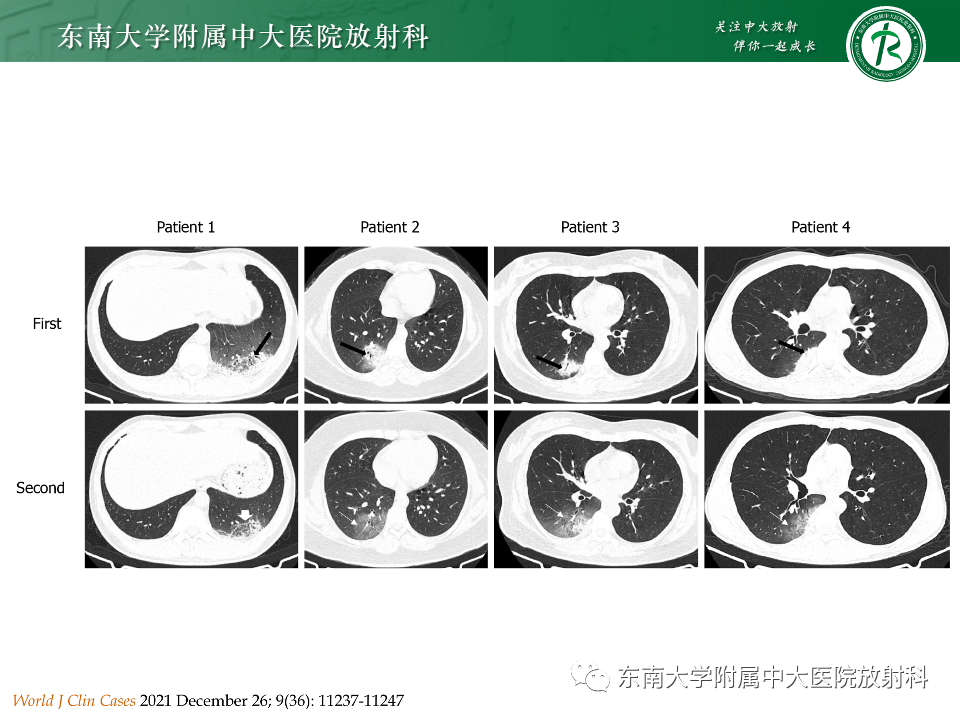 影像PPT - 【PPT】非典型性肺炎—以鹦鹉热衣原体感染为例-37