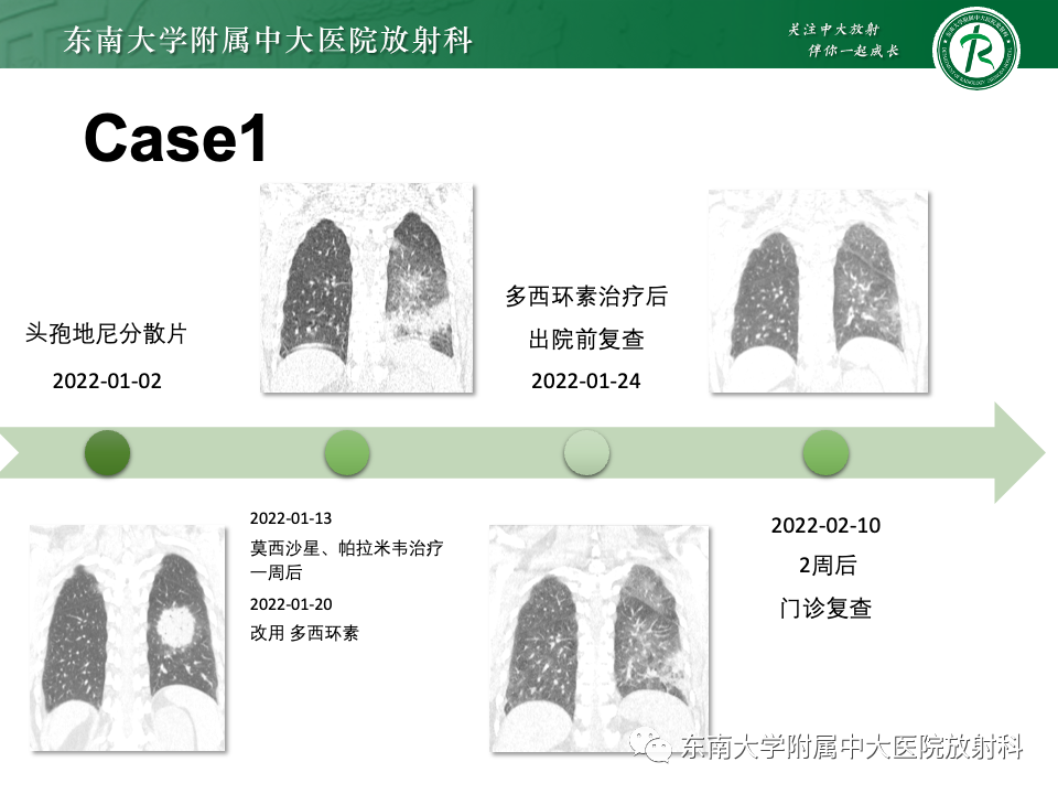 影像PPT - 【PPT】非典型性肺炎—以鹦鹉热衣原体感染为例-38