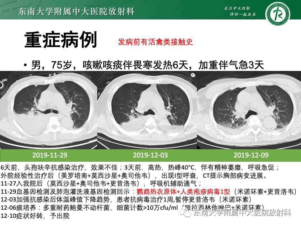 影像PPT - 【PPT】非典型性肺炎—以鹦鹉热衣原体感染为例-39