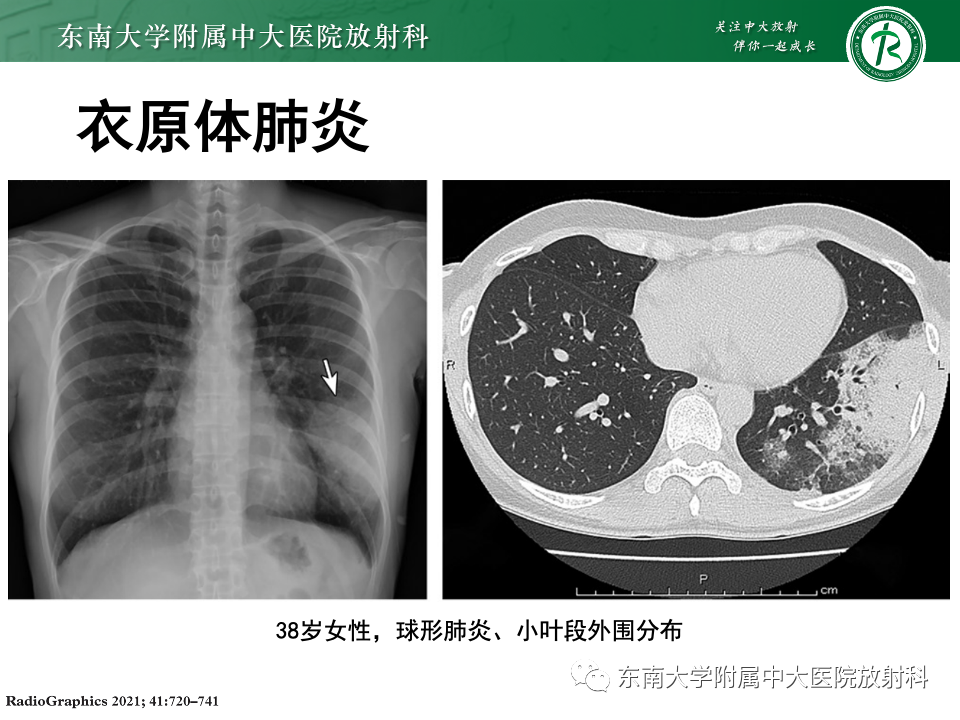 影像PPT - 【PPT】非典型性肺炎—以鹦鹉热衣原体感染为例-44