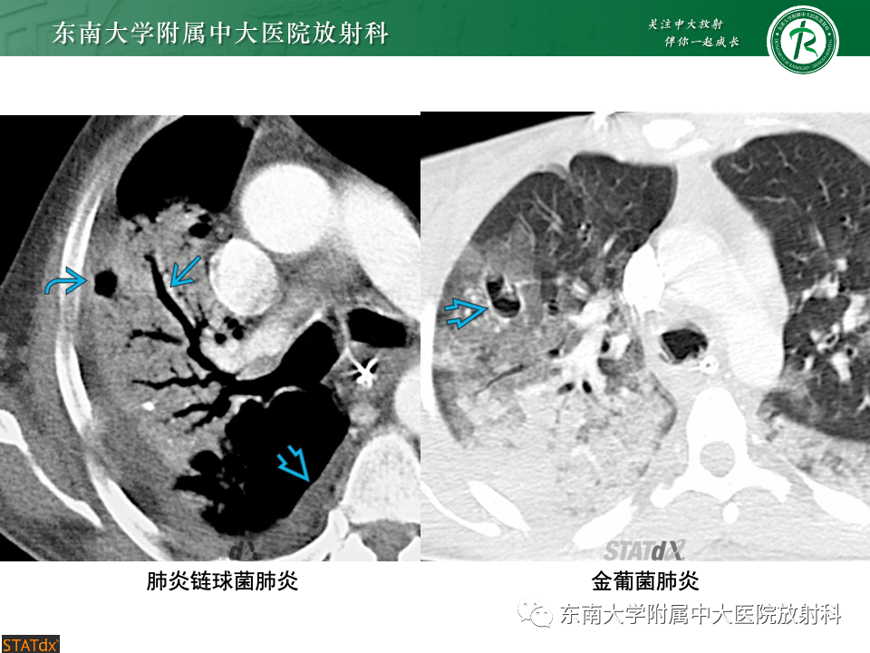 影像PPT - 【PPT】非典型性肺炎—以鹦鹉热衣原体感染为例-45