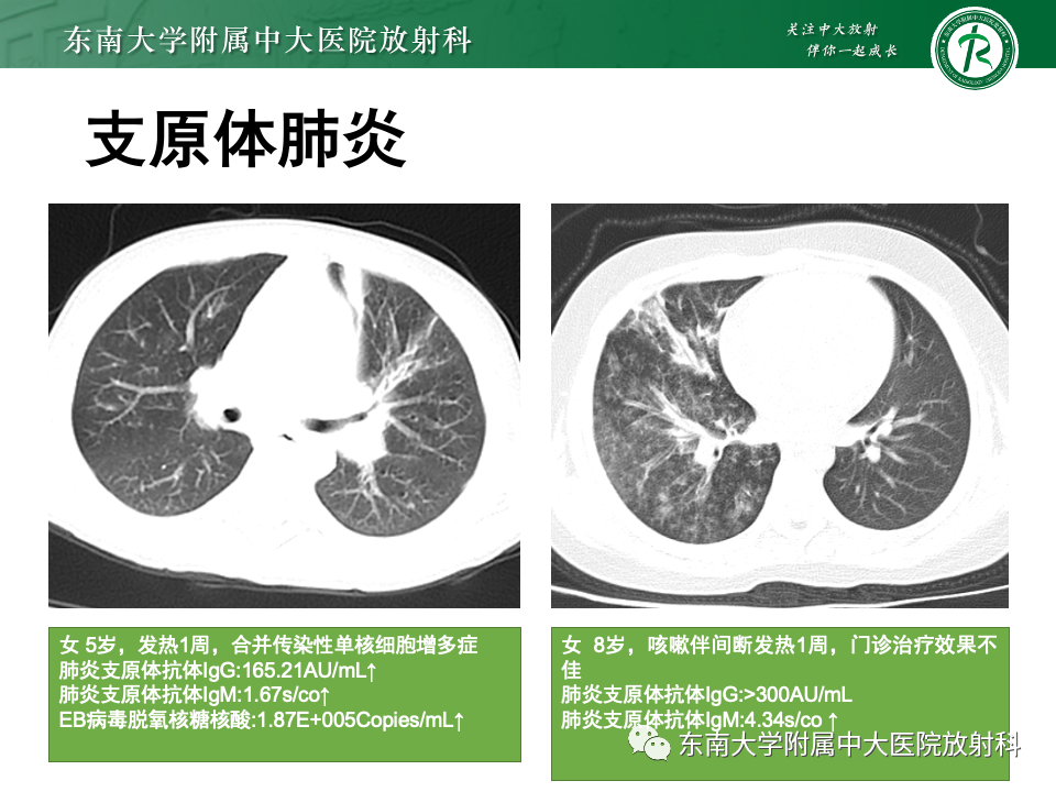 影像PPT - 【PPT】非典型性肺炎—以鹦鹉热衣原体感染为例-46