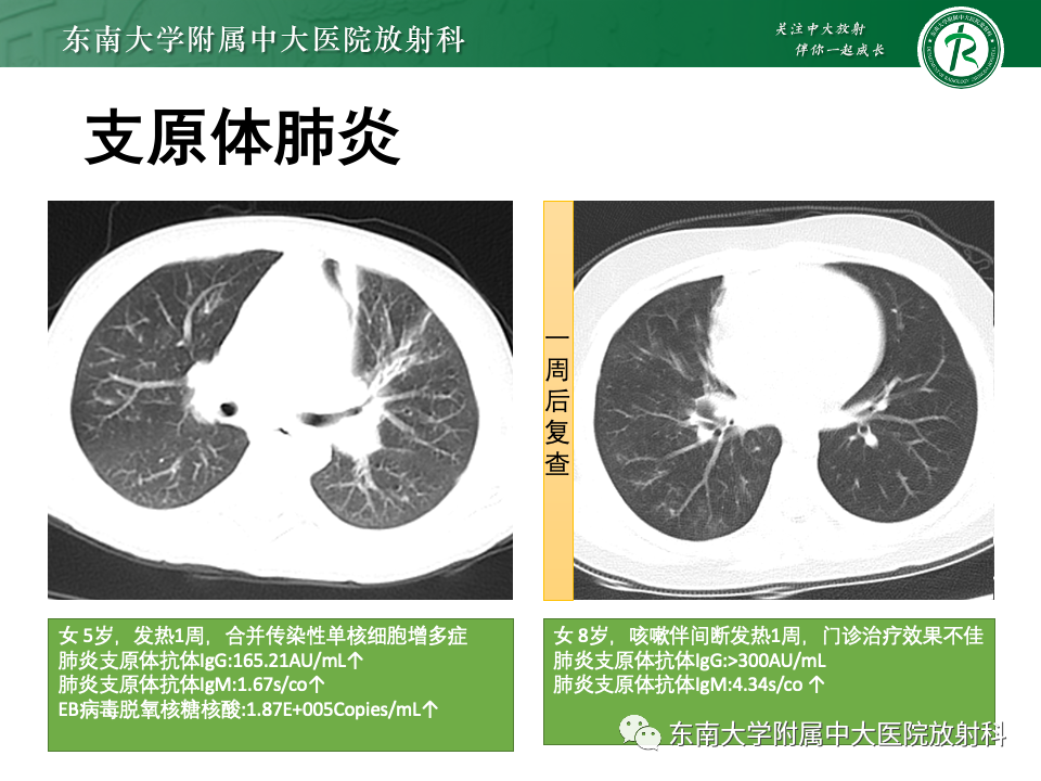 影像PPT - 【PPT】非典型性肺炎—以鹦鹉热衣原体感染为例-47