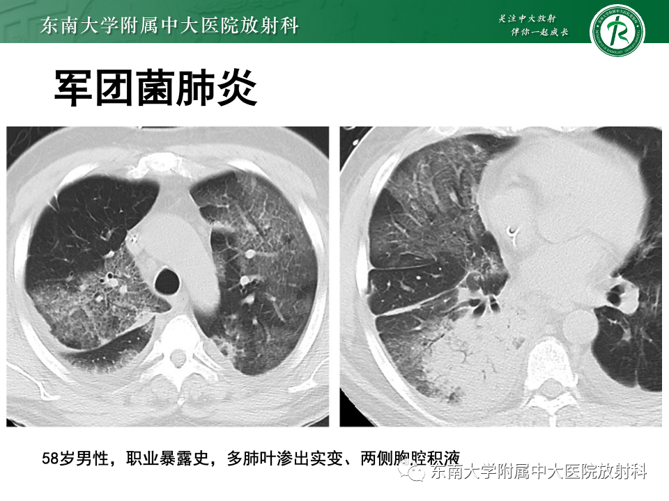 影像PPT - 【PPT】非典型性肺炎—以鹦鹉热衣原体感染为例-48