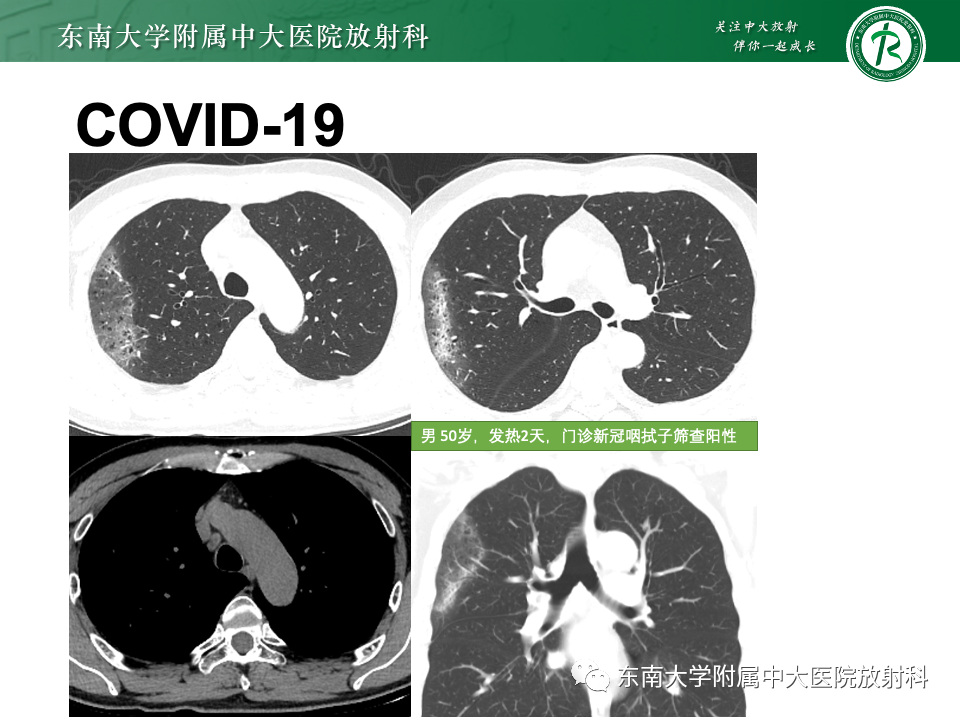 影像PPT - 【PPT】非典型性肺炎—以鹦鹉热衣原体感染为例-49