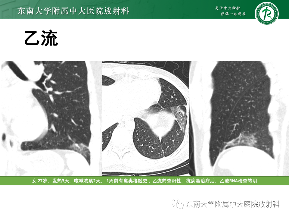 影像PPT - 【PPT】非典型性肺炎—以鹦鹉热衣原体感染为例-50