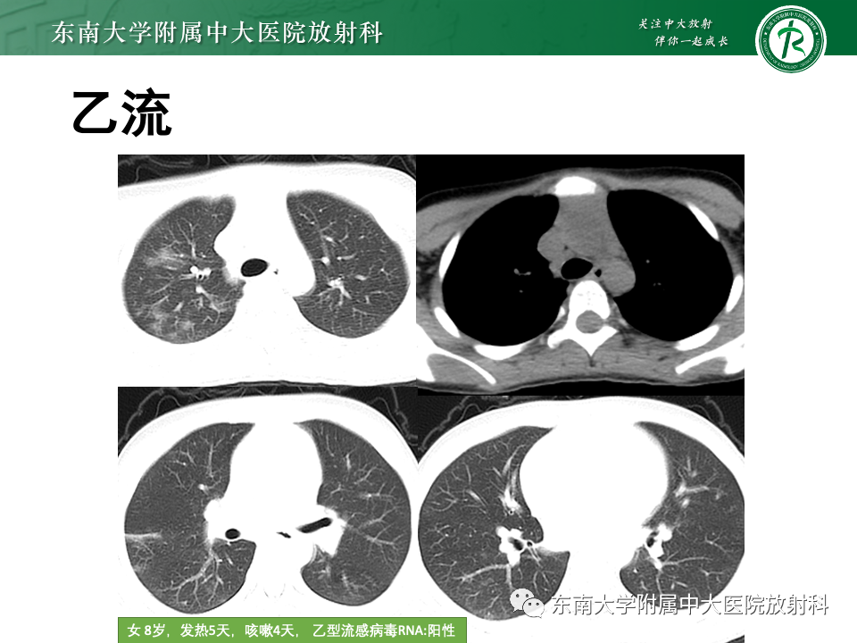 影像PPT - 【PPT】非典型性肺炎—以鹦鹉热衣原体感染为例-51