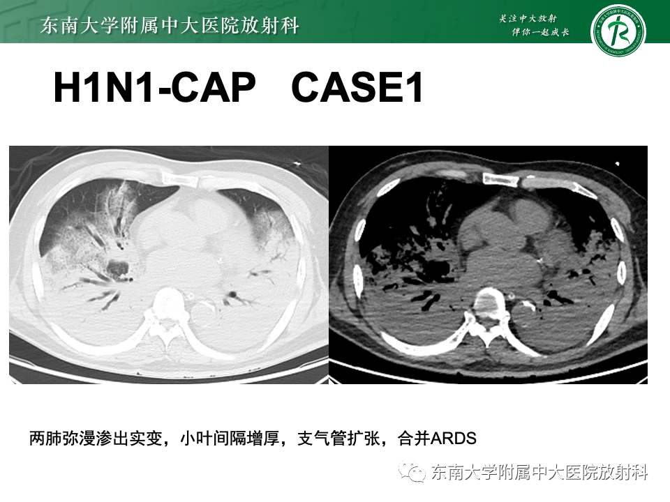 影像PPT - 【PPT】非典型性肺炎—以鹦鹉热衣原体感染为例-56