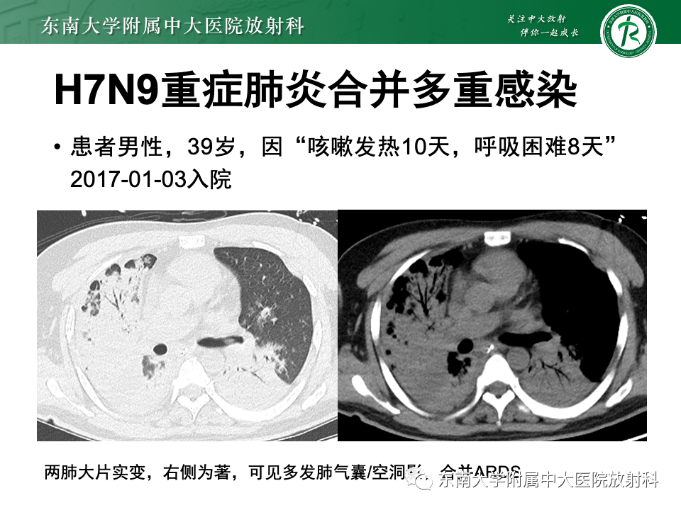 影像PPT - 【PPT】非典型性肺炎—以鹦鹉热衣原体感染为例-58