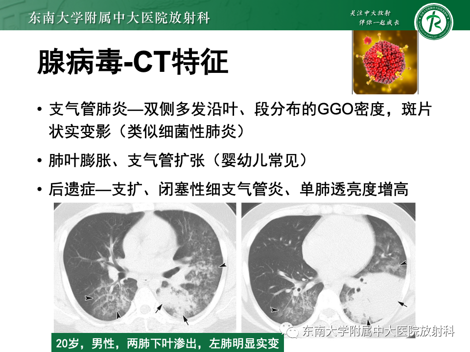 影像PPT - 【PPT】非典型性肺炎—以鹦鹉热衣原体感染为例-59