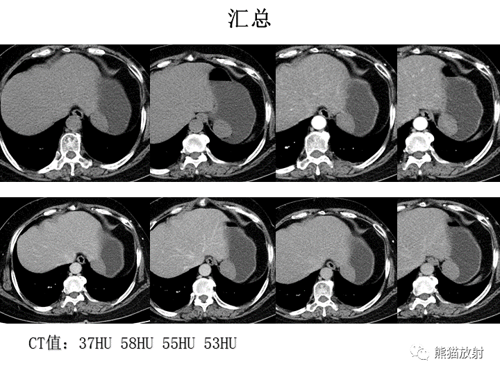影像PPT - 【病例】胃间质瘤VS神经鞘瘤-14