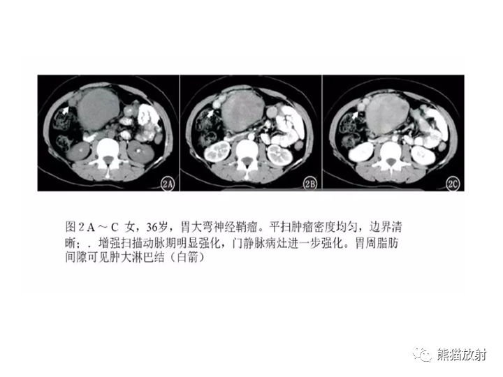 影像PPT - 【病例】胃间质瘤VS神经鞘瘤-21