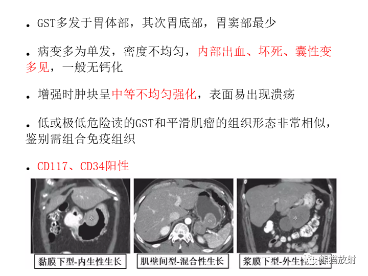 影像PPT - 【病例】胃间质瘤VS神经鞘瘤-23
