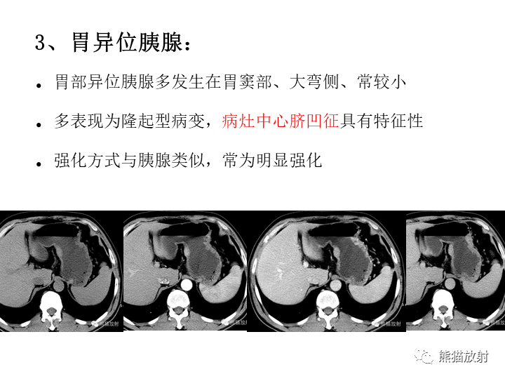 影像PPT - 【病例】胃间质瘤VS神经鞘瘤-25
