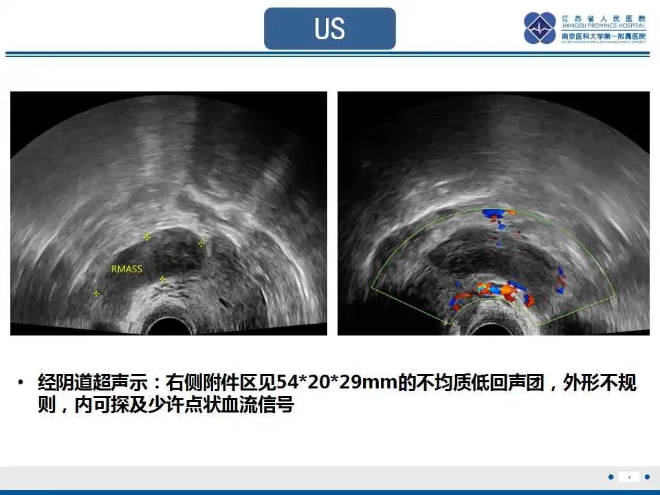 影像PPT - 【PPT】原发性输卵管癌-3