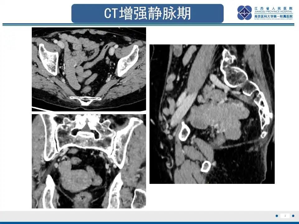 影像PPT - 【PPT】原发性输卵管癌-4