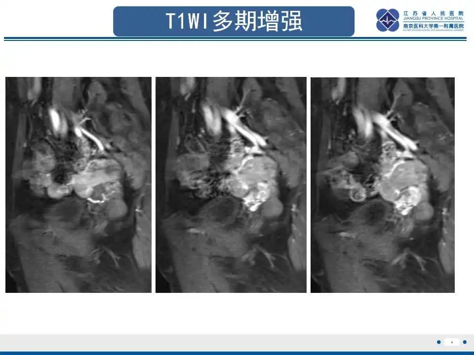 影像PPT - 【PPT】原发性输卵管癌-10