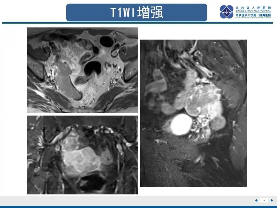 影像PPT - 【PPT】原发性输卵管癌-11