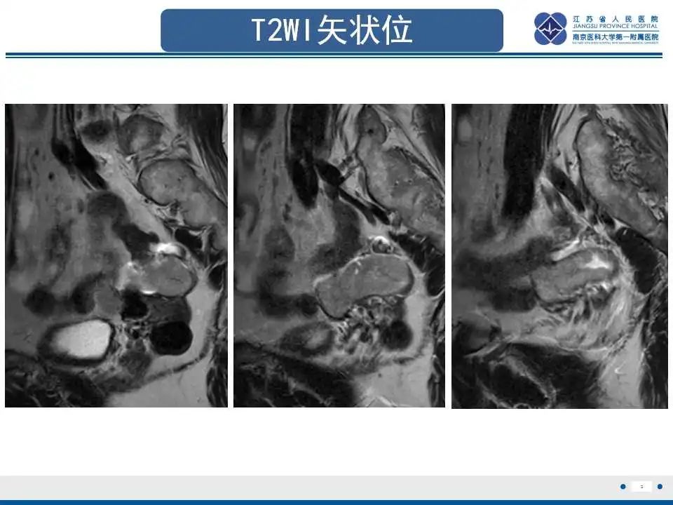 影像PPT - 【PPT】原发性输卵管癌-6