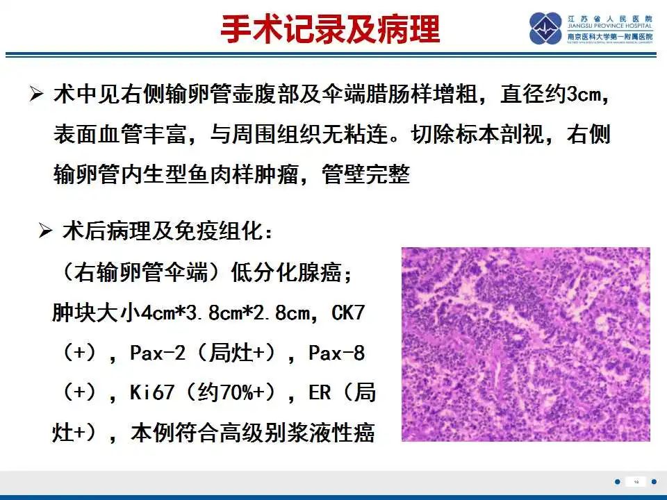 影像PPT - 【PPT】原发性输卵管癌-19