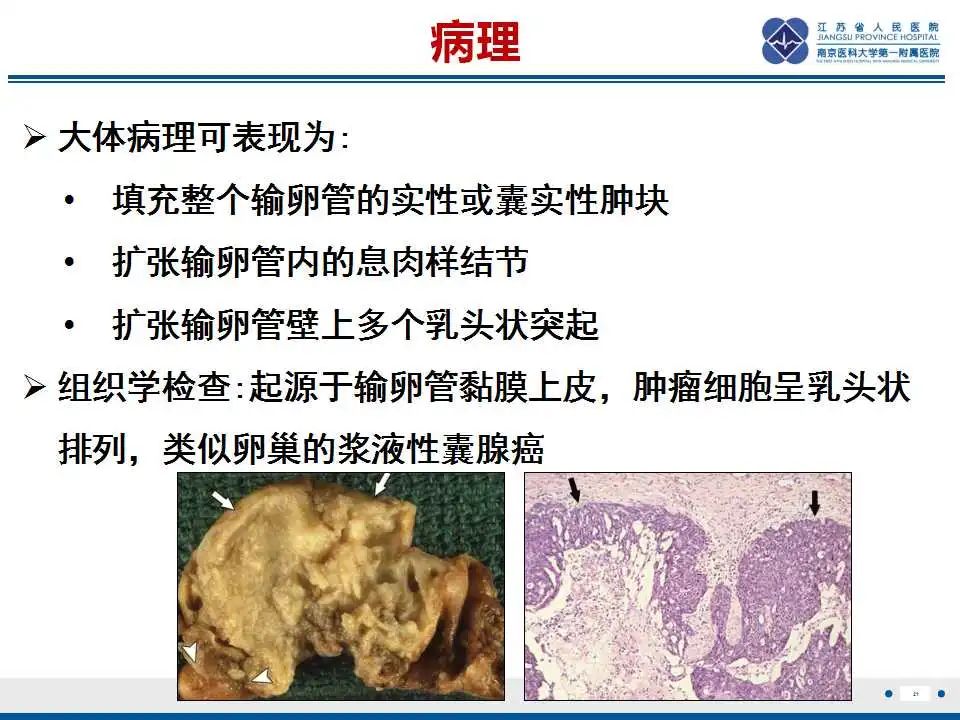 影像PPT - 【PPT】原发性输卵管癌-22