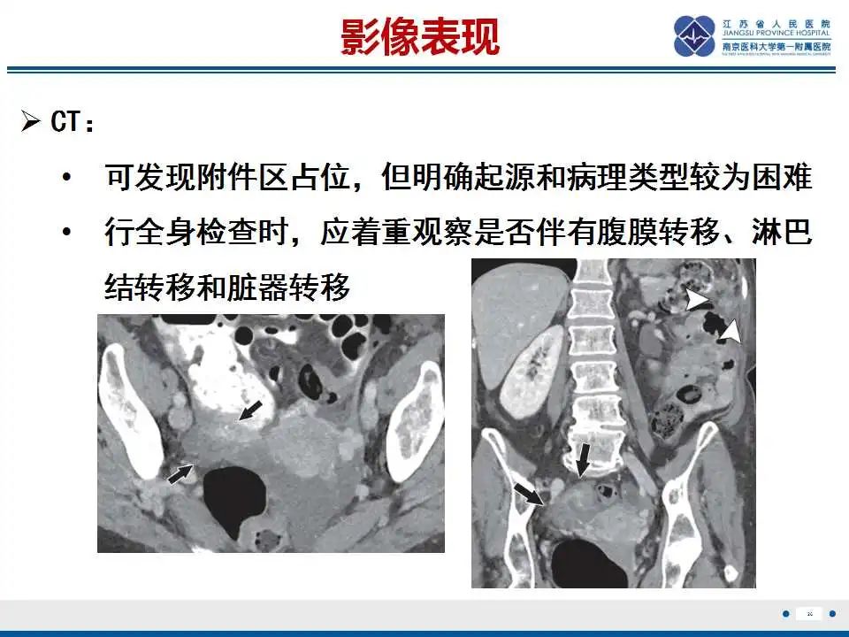 影像PPT - 【PPT】原发性输卵管癌-27