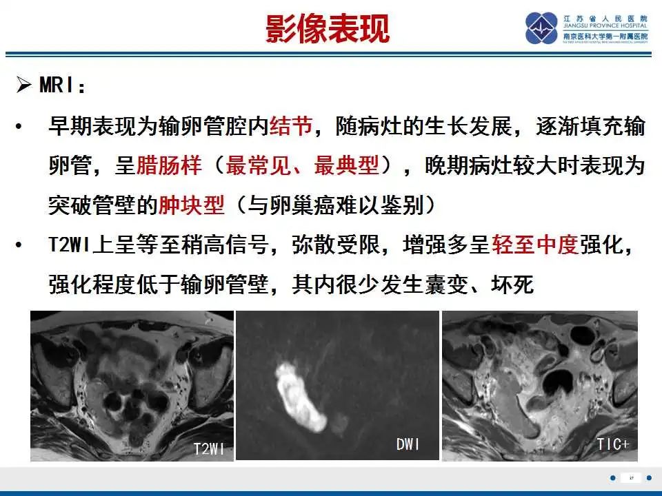 影像PPT - 【PPT】原发性输卵管癌-28