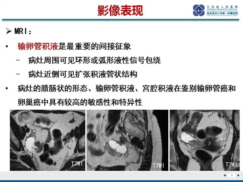 影像PPT - 【PPT】原发性输卵管癌-29