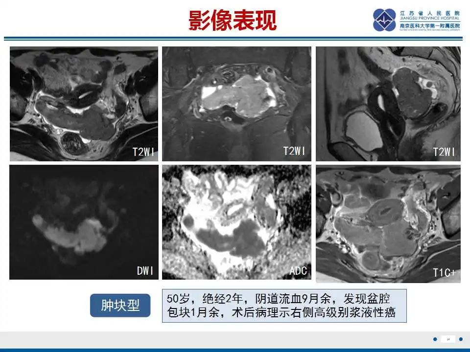 影像PPT - 【PPT】原发性输卵管癌-32