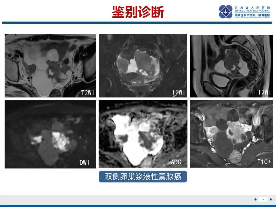 影像PPT - 【PPT】原发性输卵管癌-39