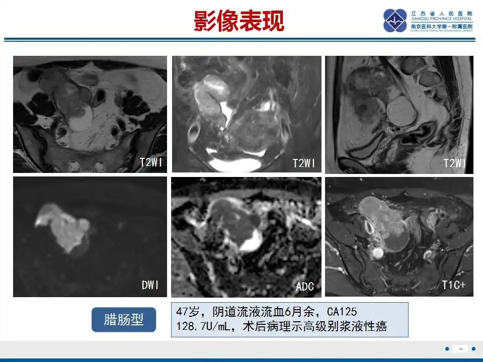 影像PPT - 【PPT】原发性输卵管癌-31