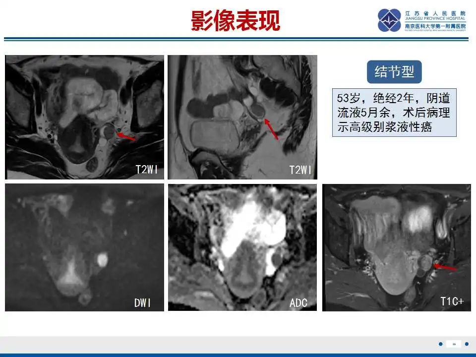 影像PPT - 【PPT】原发性输卵管癌-7
