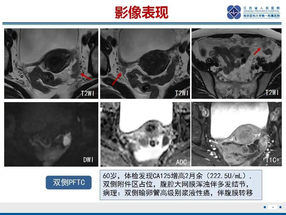 影像PPT - 【PPT】原发性输卵管癌-9