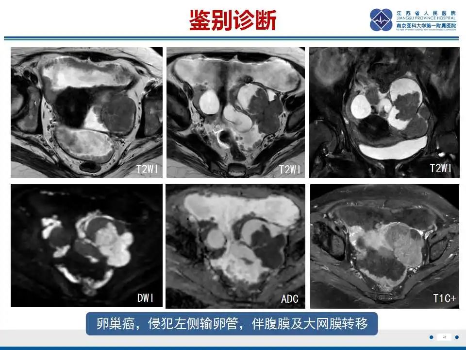 影像PPT - 【PPT】原发性输卵管癌-12