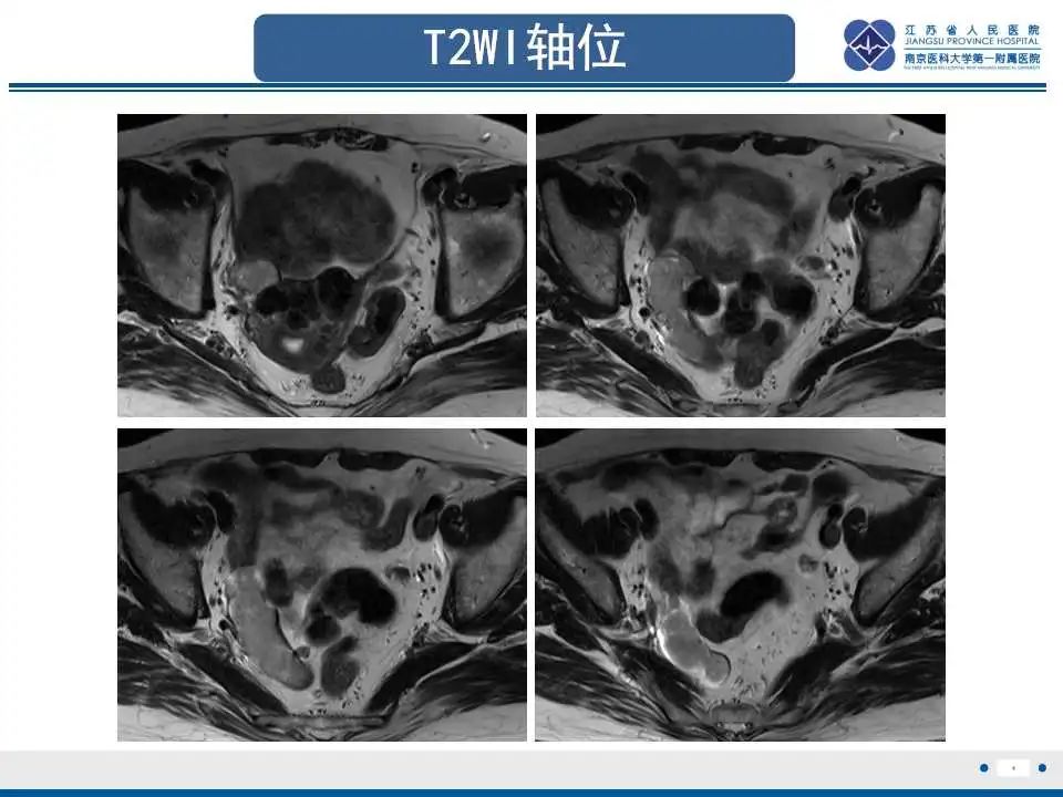 影像PPT - 【PPT】原发性输卵管癌-1